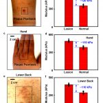 Touch sensor detects skin diseases in a minute