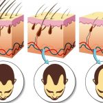 Patch-ul cu microneedle reduce pierderea părului prin creșterea fluxului de sânge la foliculi