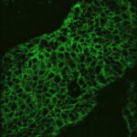 Researchers have learned to instantly detect cancer cells during surgery