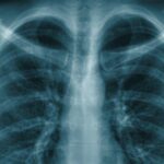 How aging can “activate” lung cancer