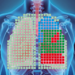 Experimental vest monitors lung function: problem areas are visible without x-rays