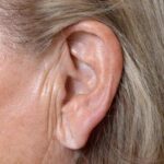 Comment connaître le risque d'infarctus par les oreilles