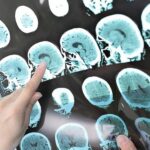 Five Signs You're Developing Multiple Sclerosis