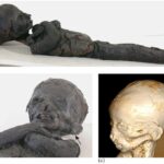 Analysis of mummies showed the prevalence of anemia in children in ancient Egypt
